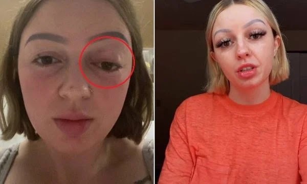 Mulher faz tanta força no parto que olho “pula para fora”: entenda