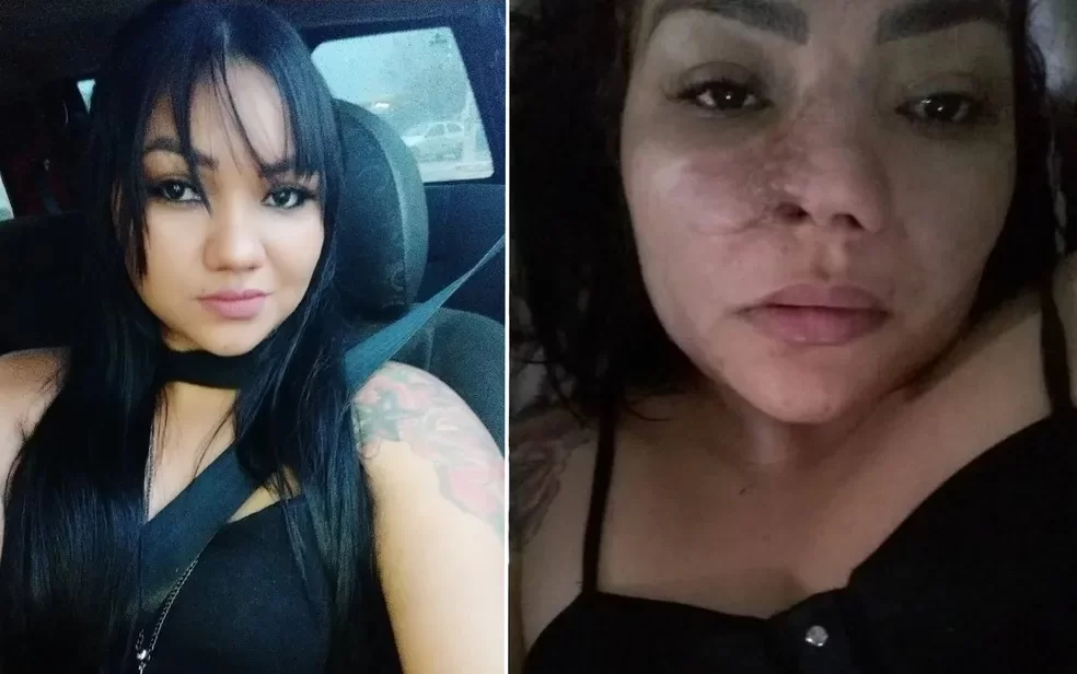 Paciente relata sentir-se enganada após perder parte do nariz em cirurgia estética