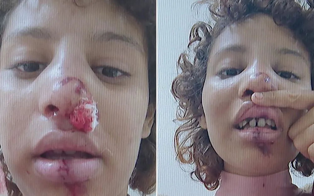 Estudante fica desfigurada após atropelamento e clama por justiça após motorista fugir