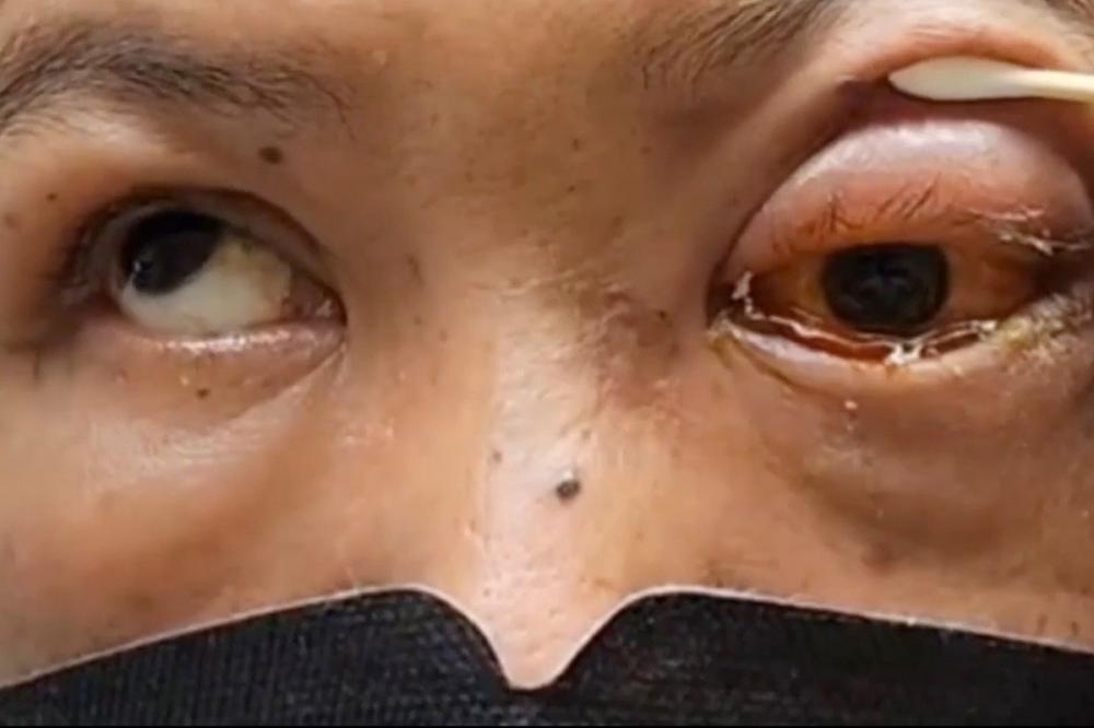 Homem fica cego de um olho após adormecer bêbado e de bruços.