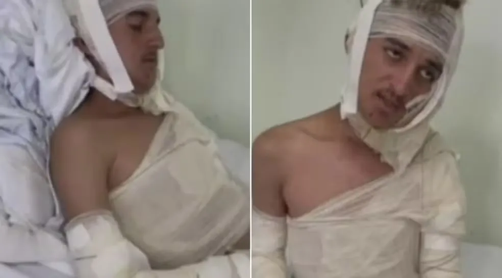 Jovem é queimado com óleo quente em ataque homofóbico no Ceará