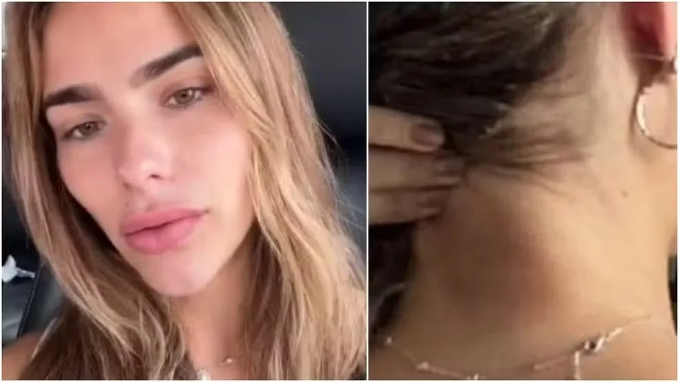 Modelo cearense denuncia ter sido agredida e empurrada da escada pelo ex-namorado 