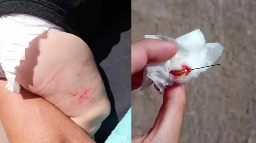 Enfermeiro esquece agulha em perna de bebê de 4 meses após aplicação de vacinas