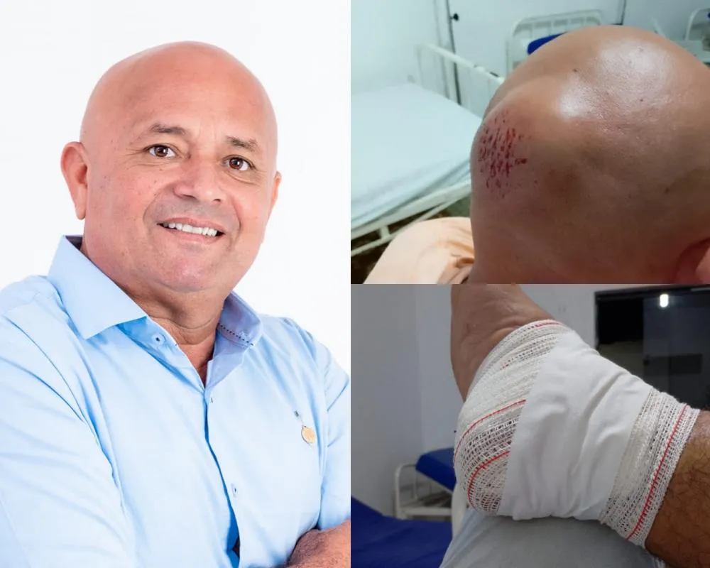 Ex-vereador de Santa Quitéria Pedro do Sangradouro é atropelado por moto em Varjota