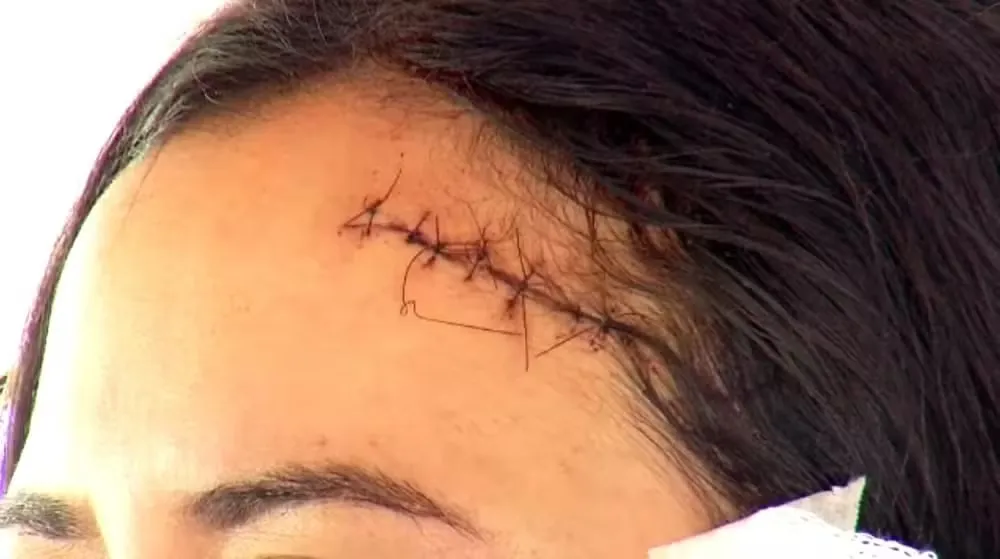 Mulher leva cadeirada na cabeça após discussão em bar para defender amiga, em Fortaleza