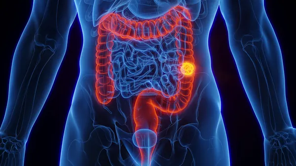 SUS adota novo exame para detectar câncer de intestino antes dos sintomas